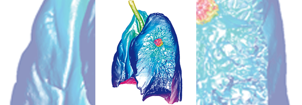 Frühe NSCLC kann man oft operieren. Ansonsten greift man zur Radio-, Chemo- oder Immuntherapie.