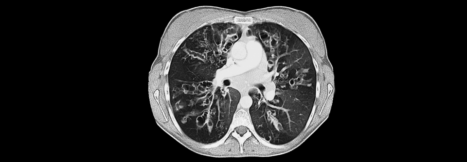Die CT eines 21-jährigen CF-Patienten: Die pulmonale Schleimansammlung fördert die Entwicklung von Infektionen.