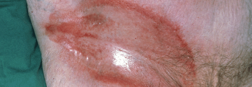 Intertrigo bei einer älteren Frau. Regionen, in denen Haut aufeinanderreibt, sind besonders anfällig für sekundäre Infektionen. 