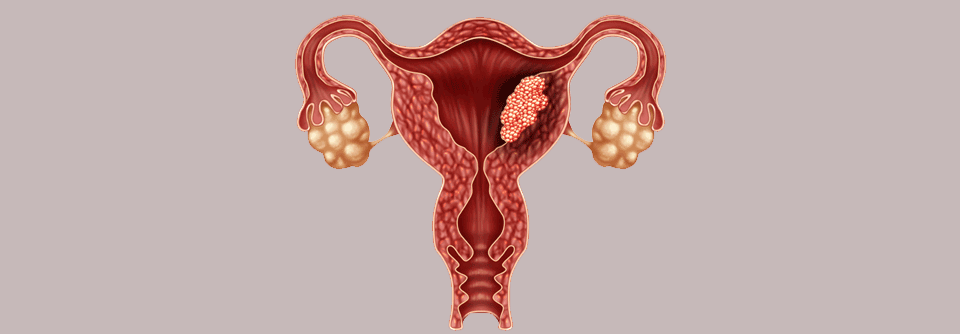 An den molekulare Veränderungen des Endometriumkarzinoms könnten zukünftig zielgerichtete Therapien ansetzen.