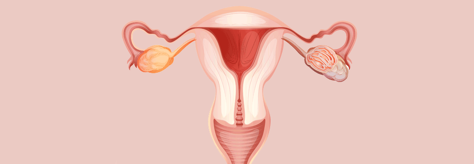 Die hypertherme intra­peritoneale Chemotherapie könnte in die Routineversorgung bei Ovarialkarzinomen aufgenommen werden.