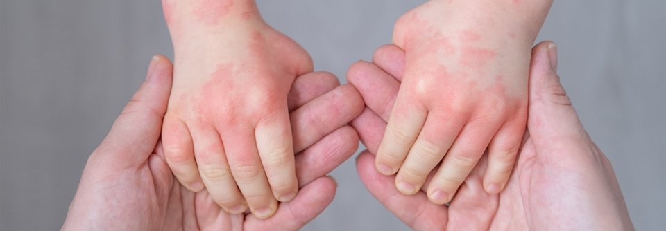 Die atopische Dermatitis (AD) beginnt meist früh im Kindesalter.