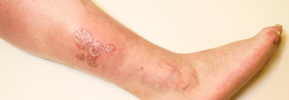 Bei akuten oder chronischen Beinschmerzen  sollte man dermatologische Krankheitsbilder nicht vergessen.