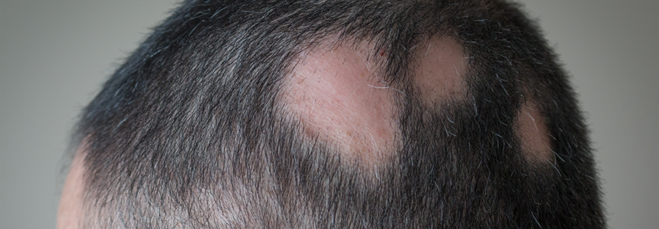 Alopecia areata ist eine Form von Haarausfall, die runde oder ovale kahle Stellen auf der Kopfhaut oder anderen Körperstellen verursacht.