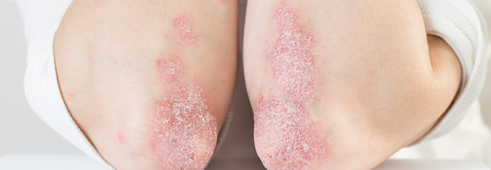 Schuppenflechte oder Psoriasis ist eine nicht-ansteckende chronische Autoimmunkrankheit, die sich vor allem als entzündliche Hautkrankheit manifestiert.