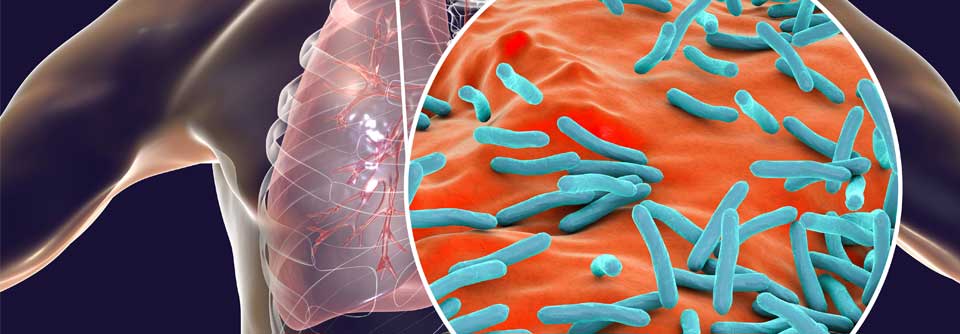 Den Ergebnissen einer Studie zufolge schützt eine Tuberkulose-Impfung weder vor einer Infektion mit SARS-CoV-2 noch vor anderen Atemwegsinfektionen.