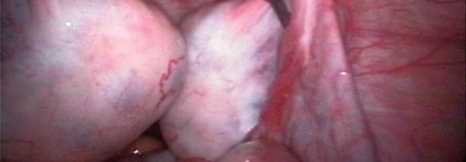 Bei exzessiver ovarieller Androgenproduktion bleibt der Eisprung aus, es bilden sich multiple Zysten (weiß).