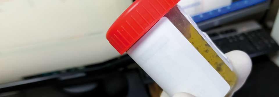 Fäkales Calprotectin: Per Labortest chronisch-entzündliche Darmerkrankungen ausschließen Der Test auf Calprotectin ist anhand einer Stuhlprobe problemlos im hausärztlichen Praxislabor durchführbar.
