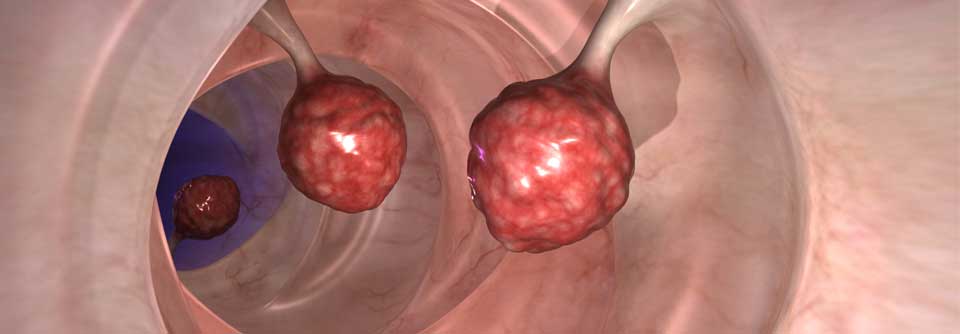 Kolorektale Adenome sollte je nach Größe und Art unterschiedlich entfernt werden.