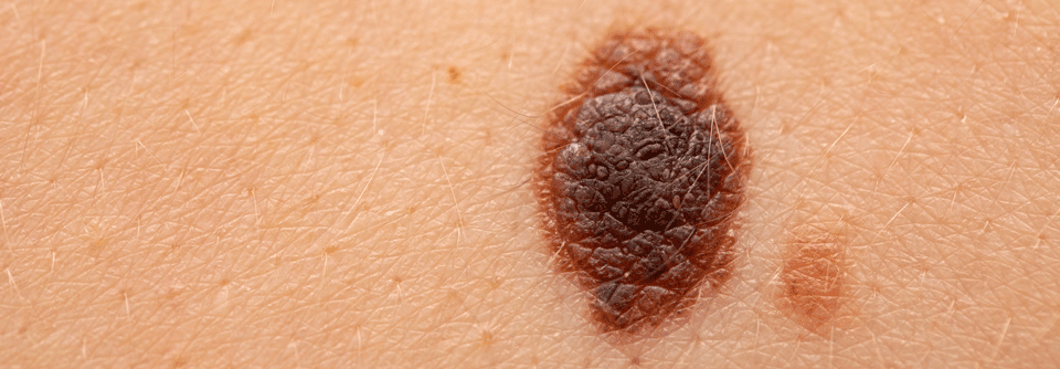 Die PD1-Inhibition von Melanomen bringt sowohl vor als auch nach der Resektion deutliche Vorteile.
