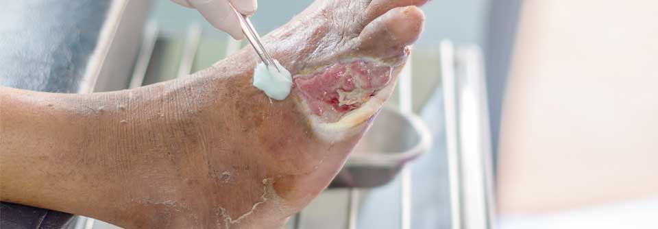 Diabetischer Fuß: Viele Ulzera heilen unter lokaler hyperbarer Sauerstofftherapie Erster Schritt in der Therapie diabetischer Fußulzera ist das Débridement.