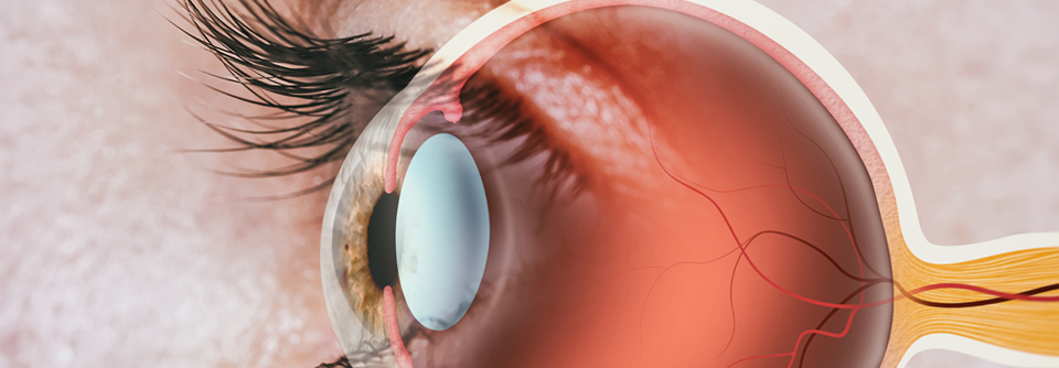 Eine Retinopathie ist eine Schädigung der Netzhaut des Auges.