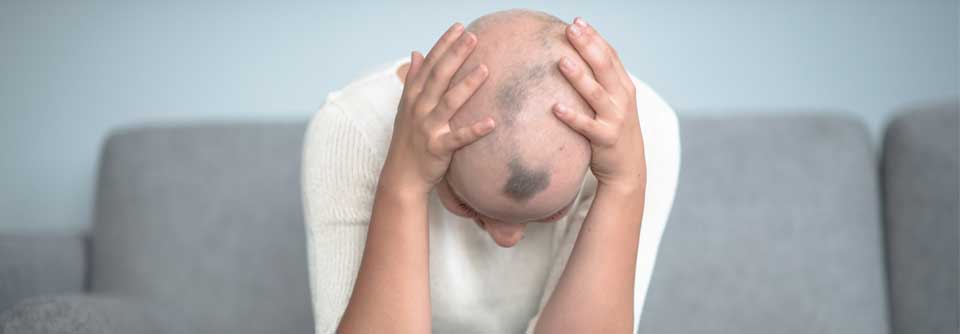 Laut einer Studie auf Basis von US-Krankenversicherungsdatenbanken nimmt die Inzidenz der Alopecia areata zu. 
