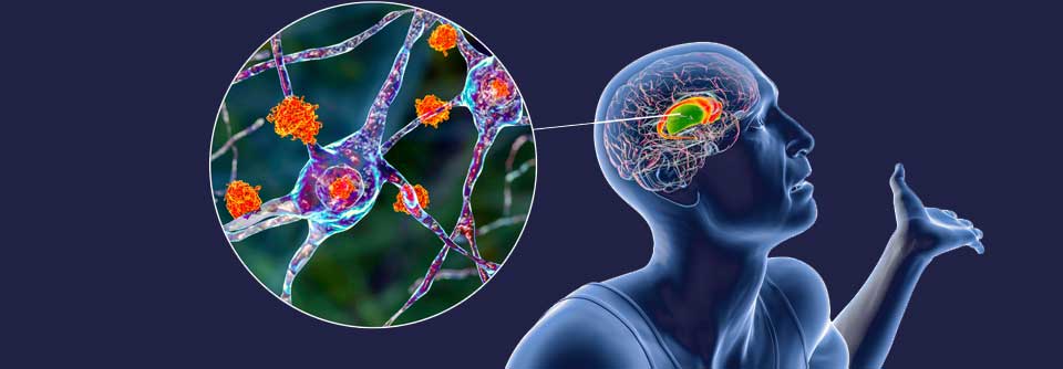 Nach einer sauberen Diagnostik, stehen für die Behandlung des Morbus Huntington verschiedene Therapiemöglichkeiten zur Verfügung. Dabei ist auf die individuelle Lage der Patient:innen zu achten.