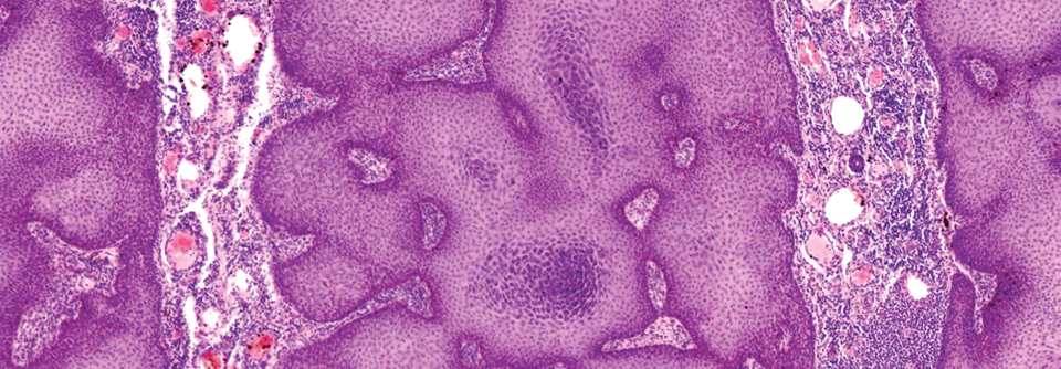 Larynxpapillom im histologischen Schnitt.  
