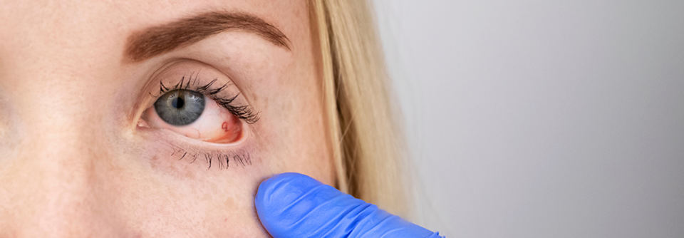 Die Uveitis ist eine Entzündung der Augenhaut und kann in unterschiedlicher Weise auftreten.