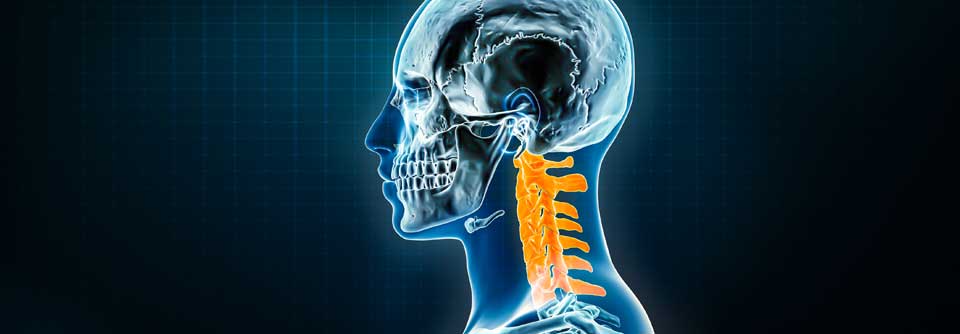 Bei Patient:innen mit rheumatoider Arthritis, die über Knirschen im HWS-Bereich klagen, sollte dringend eine Röntgenaufnahme veranlasst werden - im schlimmsten Fall droht die hohe Querschnittlähmung.