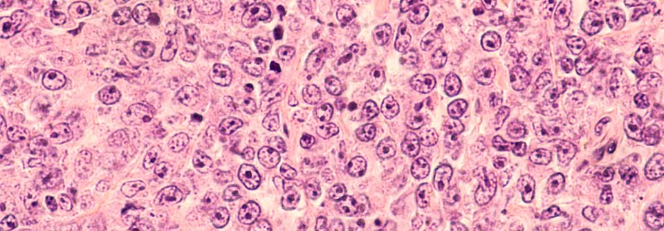 Im Mai erfolgt die Markteinführung von Loncastuximab-Tesirin.