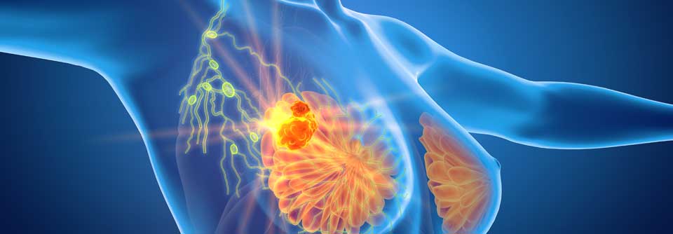 Mit der Zulassung steht nun Abemaciclib zur Behandlung des HR+/HER2- frühen Brustkrebs mit hohem Rezidivrisiko zu Verfügung.
