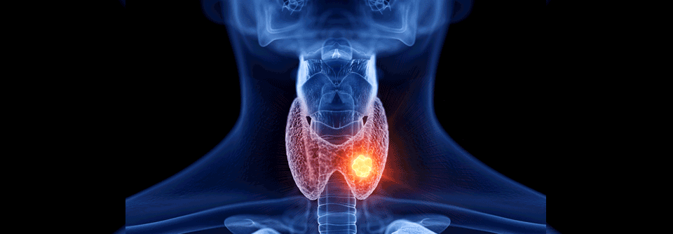 Für die Therapie von Patient:innen mit metastasierten medullären Schilddrüsenkarzinomen sind schon länger Multikinase-Inhibitoren verfügbar.