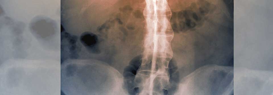 Fortgeschrittene axiale Spondyloarthritis bei einer 56-jährigen Patientin (coloriertes Röntgenbild).