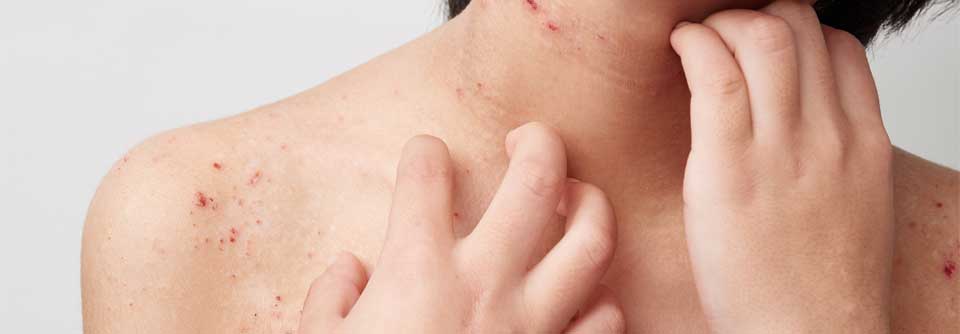 Dupilumab von der Europäischen Kommission als erste und einzige innovative Systemtherapie der schweren atopischen Dermatitis bei Kindern ab 6 Monaten zugelassen AD ist eine chronische Hauterkrankung, der eine Typ-2-Inflammation zugrunde liegen kann.