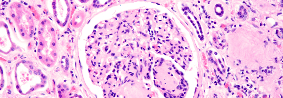 Aktuelle Leitlinien empfehlen Finerenon als dritte Säule neben RAS- und SGLT2-Hemmern bei Typ-2-Diabetes mit CKD.