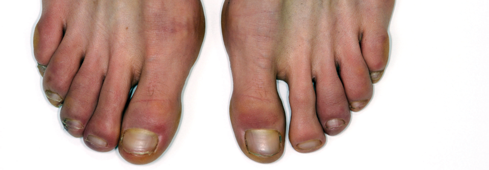 Frostbeulen an den Zehen einer Patientin mit Raynaud-Syndrom.
