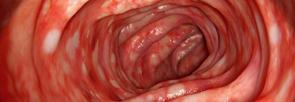 Vedolizumab blockiert die Entstehung intestinaler Entzündungen und kann so bei einer Pouchitis eingesetzt werden.