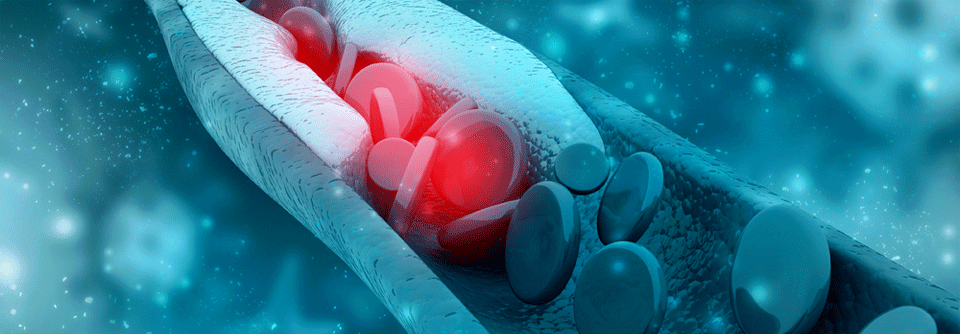 Jeweils zu Studienbeginn hatte man bei allen die CRP-Werte und das LDL-Cholesterin gemessen. Erstere galten als Marker für das unter der Statintherapie verbleibende inflammatorische Restrisiko, Letztere für das cholesterinbedingte.