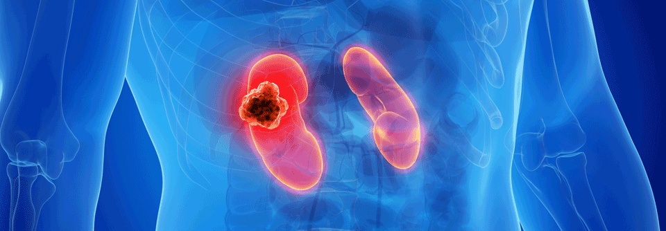 In der CONTACT-03-Studie wird untersucht, ob nach der Behandlung des mRCC durch Checkpoint-Inhibitoren eine erneute Immuntherapie folgen sollte. 