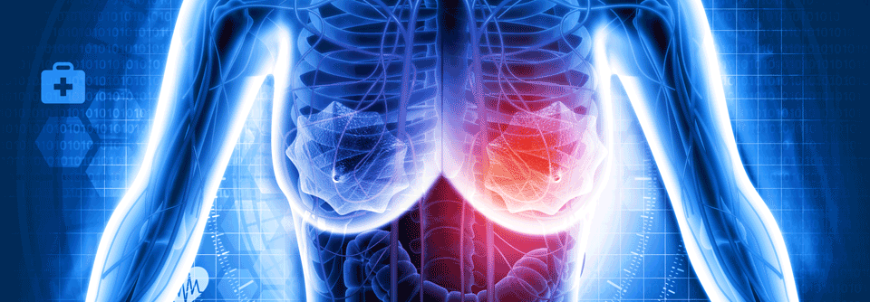 Der CDK4/6-Inhibitor punktet nicht nur mit seiner Wirksamkeit, einem günstigen Nebenwirkungsprofil und einem Überlebensvorteil sondern auch mit einem einfachen Monitoring.