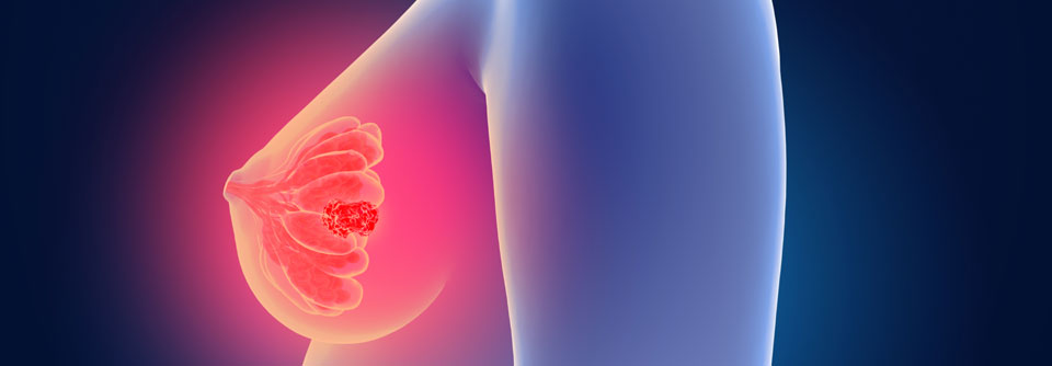 Sacituzumab-Govitecan (Trodelvy®­) kann zur Behandlung des triple-negativen Mammakarzinoms eingesetzt werden.