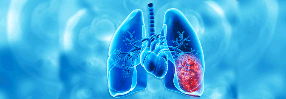 Bei ausgewählten Patient:innen können kleine Lungentumoren sublobär reseziert werden. 