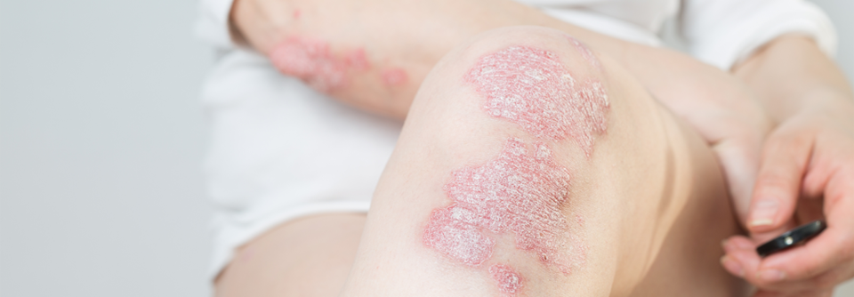 Vor allem die schwere Psoriasis sorgt für eine systemische Entzündung.