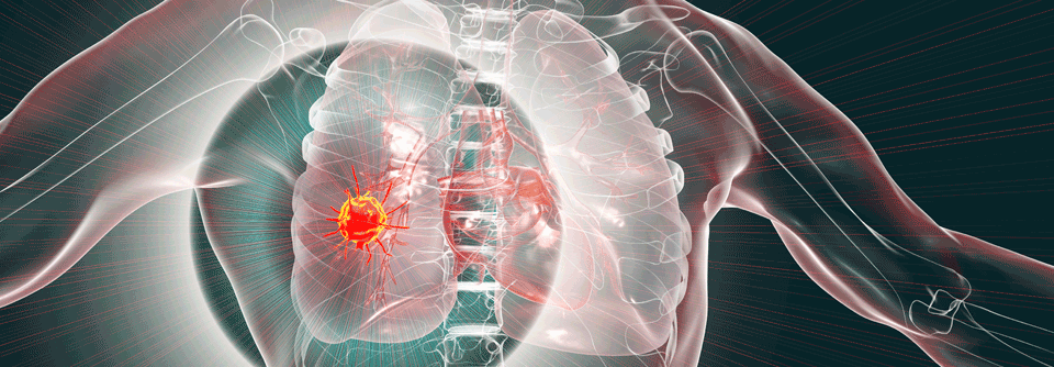 In einer Phase-3-Studie konnte das Gesamtüberleben von NSCLC-Patient:innen durch Tumor Treating Fields im Median um etwa drei Monate verlängert werden.