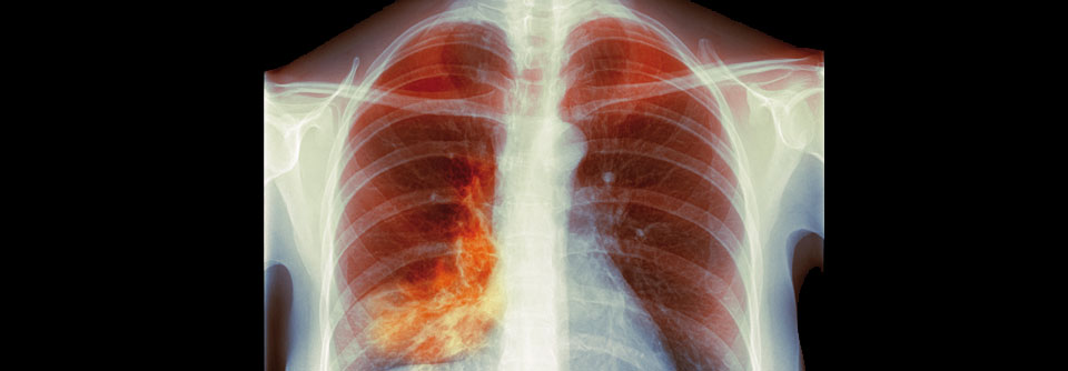 Wenn hinter einer entzündeten Lunge multiresistente Keime stecken, sind neue Strategien gefragt.