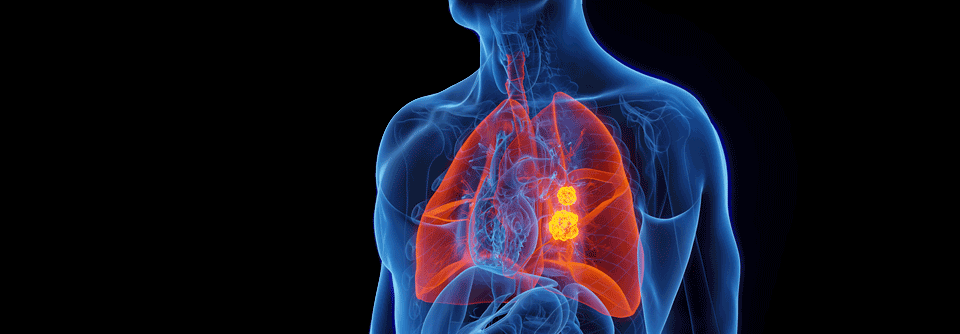 Der bispezifische T-Zell-Engager (BiTE) scheint eine Wirksamkeit bei kleinzelligen Lungentumoren und neuroendokrinen Karzinomen aufzuweisen.