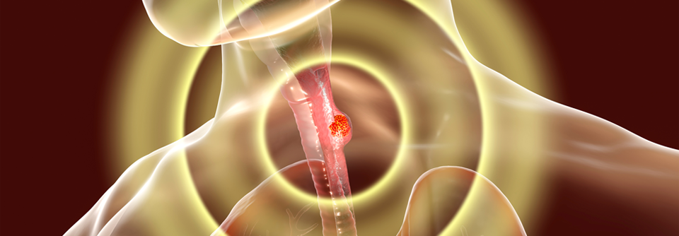 Der Grund für die Probleme ist ein Reflux, der sich aufgrund der operativ veränderten Anatomie bei der Mehrzahl der Patienten ausbildet. 