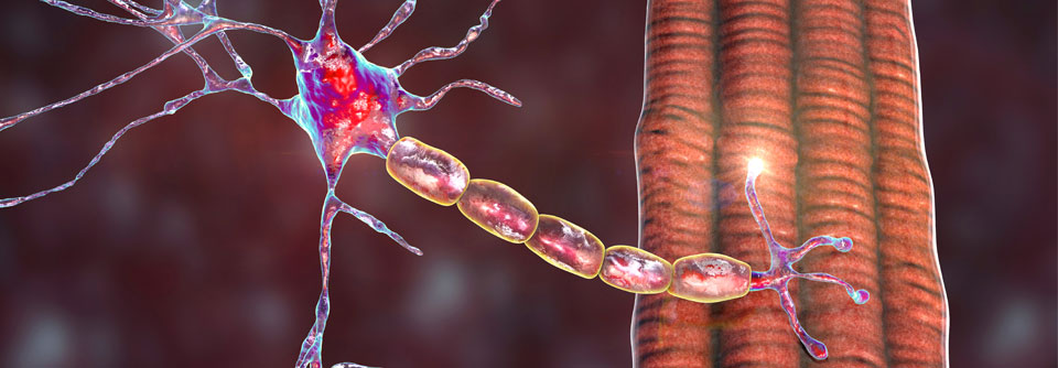 Die generalisierte Myasthenia gravis manifestiert sich bei Frauen meist vor dem 40., bei Männern eher nach dem 60. Lebensjahr. 