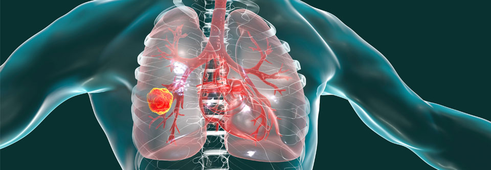 Cemiplimab kann seit März 2023 mit einer Chemotherapie kombiniert und für die Behandlung des NSCLC eingesetzt werden.