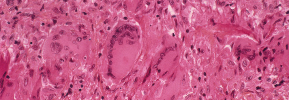 Entzündetes arterielles Gewebe mit Riesenzelle (Bildmitte) bei Morbus Horton.