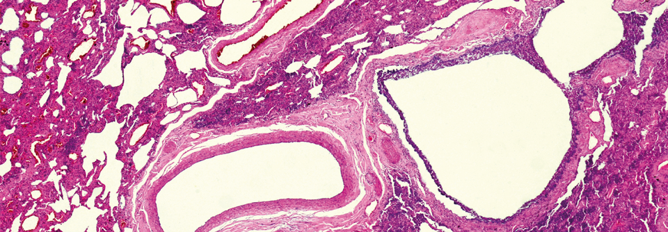 Bei Fibrose proliferiert das Bindegewebe zwischen Alveolen und Blutgefäßen. Das infolgedessen verhärtete und vernarbte Lungengewebe erschwert die Atmung.