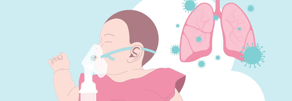 Eine passive Immunisierung von Schwangeren könnte Säuglinge nach der Geburt vor einer RSV-Infektion schützen.