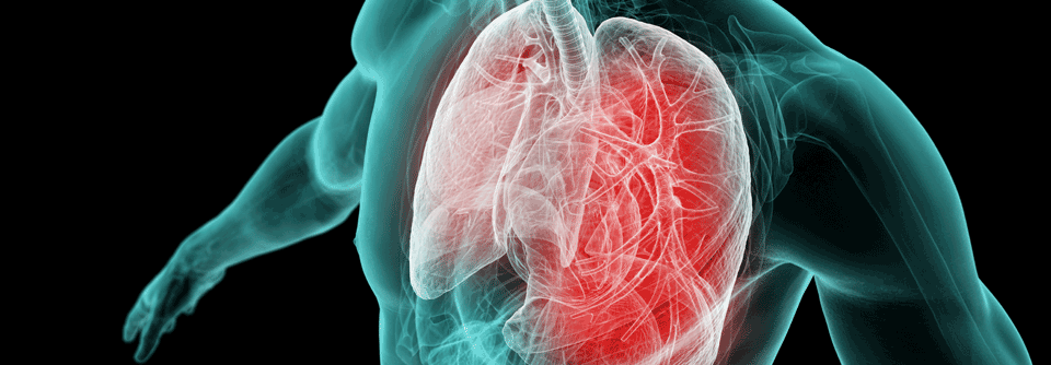 Verschiedene Kombinationen mit Immuncheckpoint-Inhibitoren und Chemotherapien könnten in frühen NSCLC Stadien erfolgreich angewendet werden. 