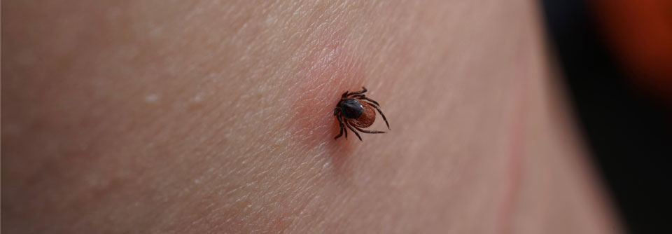 Bei akuten schweren Rückenschmerzen an Borreliose denken Ein Erythema migrans tritt nicht bei allen Patient:innen auf.