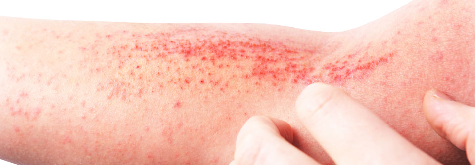 Fast die Hälfte (48,2 %) der befragten Probanden und Probandinnen litt an atopischer Dermatitis, die damit unter den Befragten, die am häufigsten vertretene Hauterkrankung darstellte. 