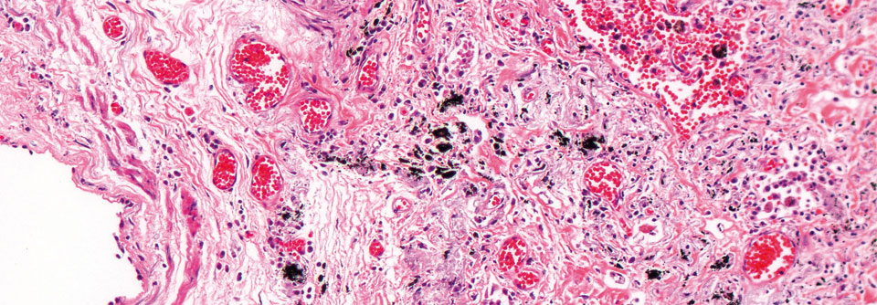 chILD: Bei Verdacht spezialisierte Zentren kontaktieren Mit antiproliferativ wirksamen Substanzen will man bei interstitieller Lungenerkrankung die Entwicklung von Fibrosen verlangsamen.