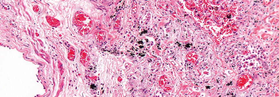 Mit antiproliferativ wirksamen Substanzen will man bei interstitieller Lungenerkrankung die Entwicklung von Fibrosen verlangsamen.