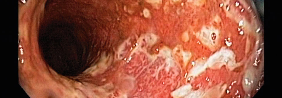 Endoskopische Sicht auf entzündete und ulzerierende Schleimhaut bei aktiver Colitis im Bereich des Sigmas.